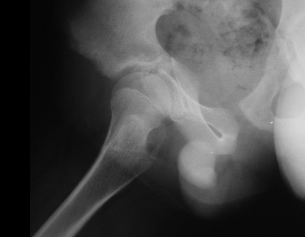 Figura 55: Radiografia em Lowentein do lado operado. Reconstrução anatômica.