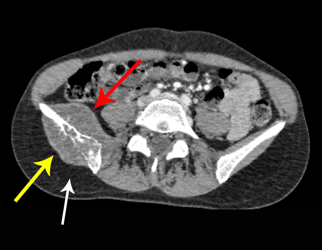 Figura 89: Tomografia axial evidenciando a lesão lítica agressiva no ilíaco direito, com erosão da cortical e tumor extra cortical com focos salpicados de condensação óssea.