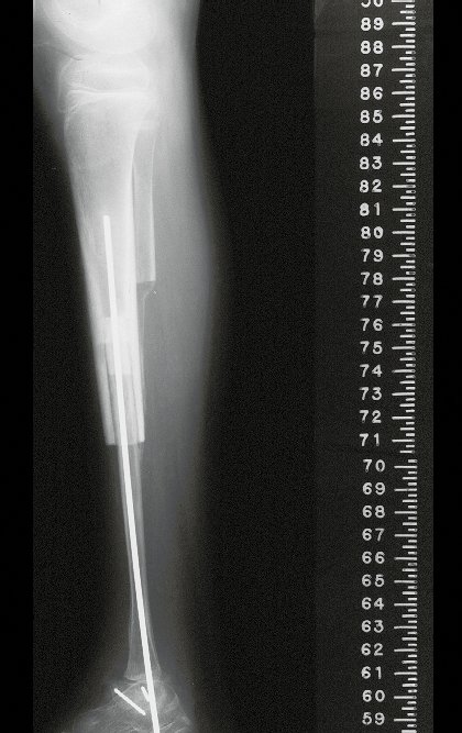 Figura 34: Radiografia perfil, após três meses da reconstrução.