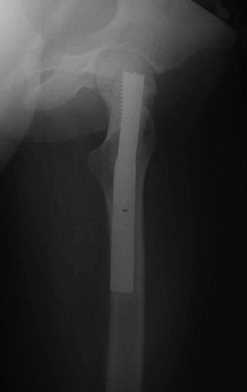 Figura 89: Radiografias de controle de 12/04/2005, perfil, após sete meses da cirurgia, reconstituição anatômica do colo femoral.