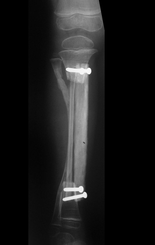 Figura 93: Radiografia do pós-operatório de seis semanas, 02/04/2010, já observamos a mineralização do periósteo fibular que foi deslocado.