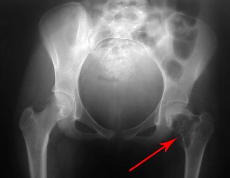 Figura 5: Radiografia da bacia de 14/10/2004, frente, com aumento da lesão e fratura do colo femoral esquerdo.