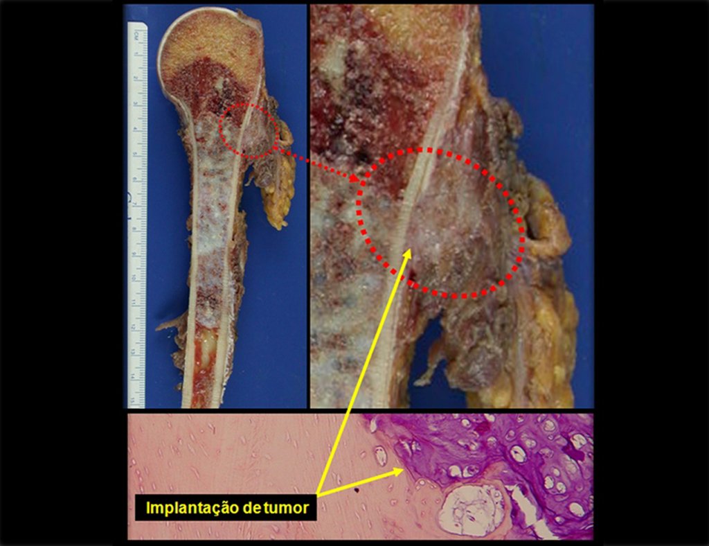 Figura 23: Corte da peça ressecada com o trajeto da biópsia contaminado, a seta destaca a lesão extra cortical e a ossificação do periósteo e a lâmina da Histologia destaca a erosão da cortical pelo tumor.