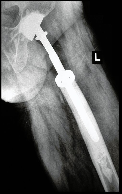 Figura 125: Radiografia do quadril, perfil, em 17/09/2015.