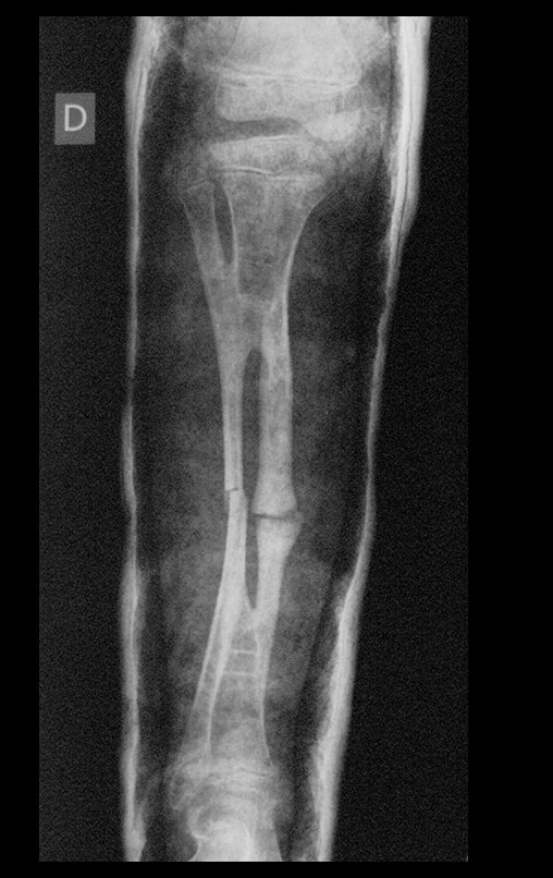 Figura 140: Radiografia de controle, frente, em 14/10/2013.