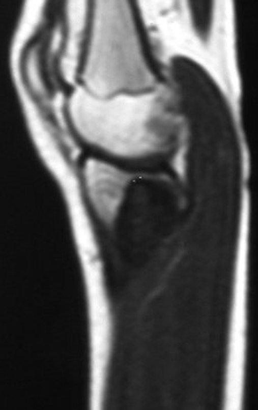 Figura 25. B: RM sag T1, pós quimioterapia.