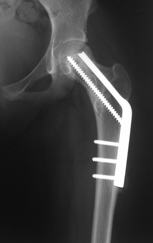 Figura 96: Radiografia do quadril operado, integração total do enxerto autólogo, reconstituição anatômica do colo femoral.