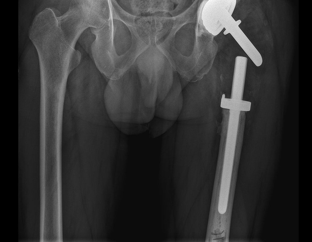 Figura 127: Radiografia de 1/2 proximal do fêmur, em 03/08/2017.