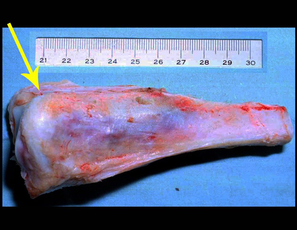 Figura 17: Peça ressecada, a seta amarela destaca a sindesmose tíbio-fibular.