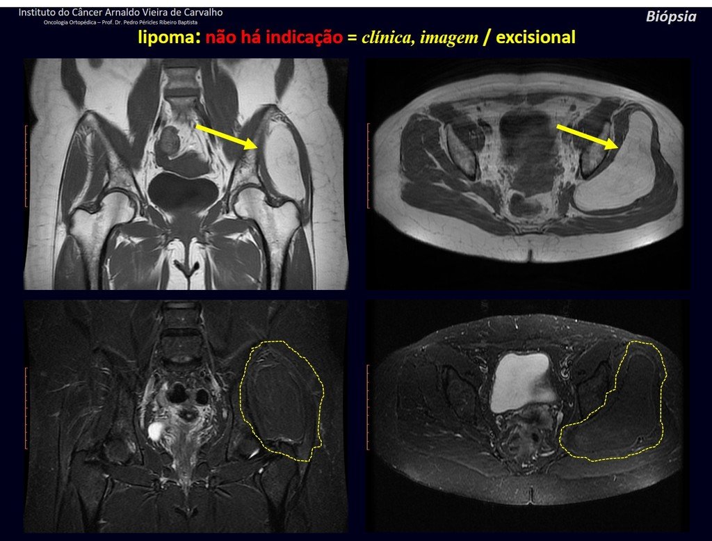 Figura 73: Tumor de tecidos moles da região glútea, homogêneo, densidade de gordura em T1, que continua com o mesmo aspecto na saturação. LIPOMA.