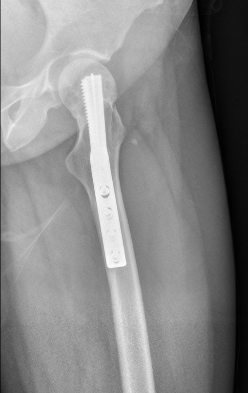 Figura 100: Radiografia em perfil, após doze anos, bom alinhamento do colo femoral.