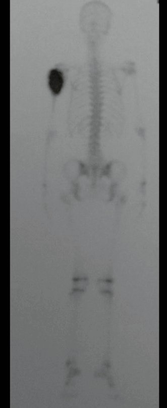 Figura 5: Cintilografia do úmero esquerdo, vista posterior.