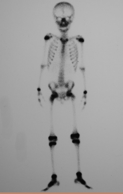 Figura 3: Radiografia em alar, grande tumor extra cortical, intra e extra pélvico.