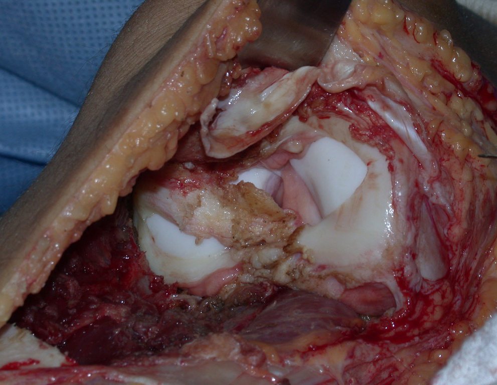 Figura 54: Os meniscos são preservados em conjunto com o complexo capsulo-ligamentar do joelho.