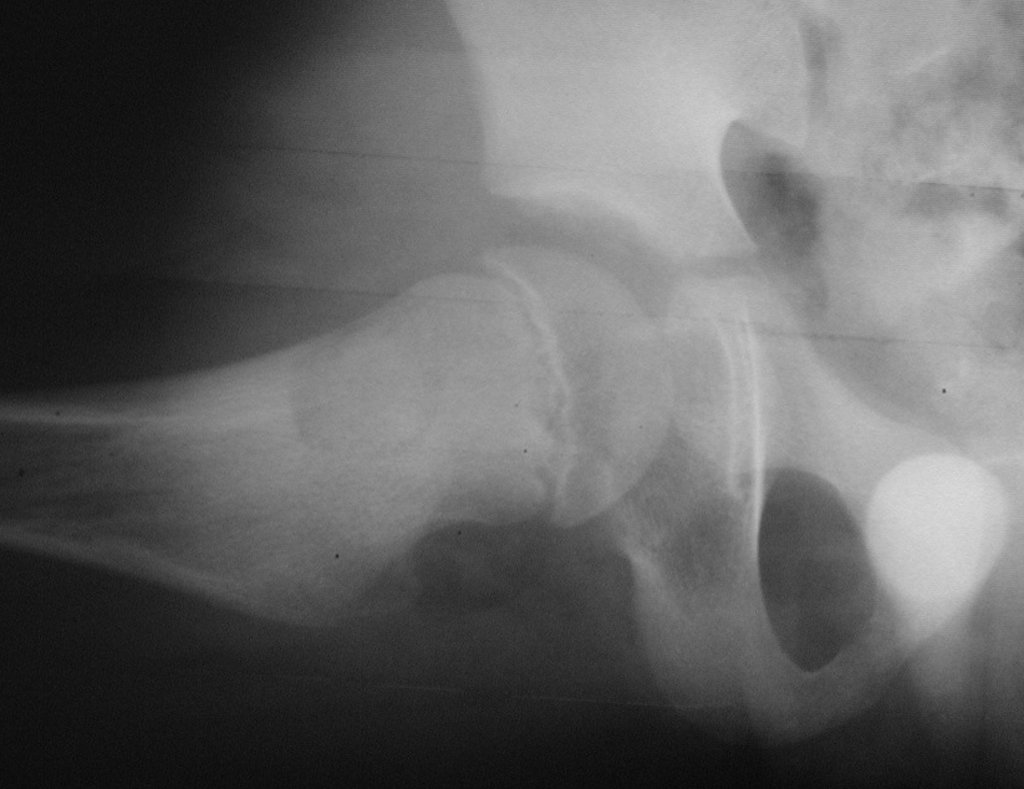 Figura 43: Radiografia em perfil, após a ressecção e reconstrução.