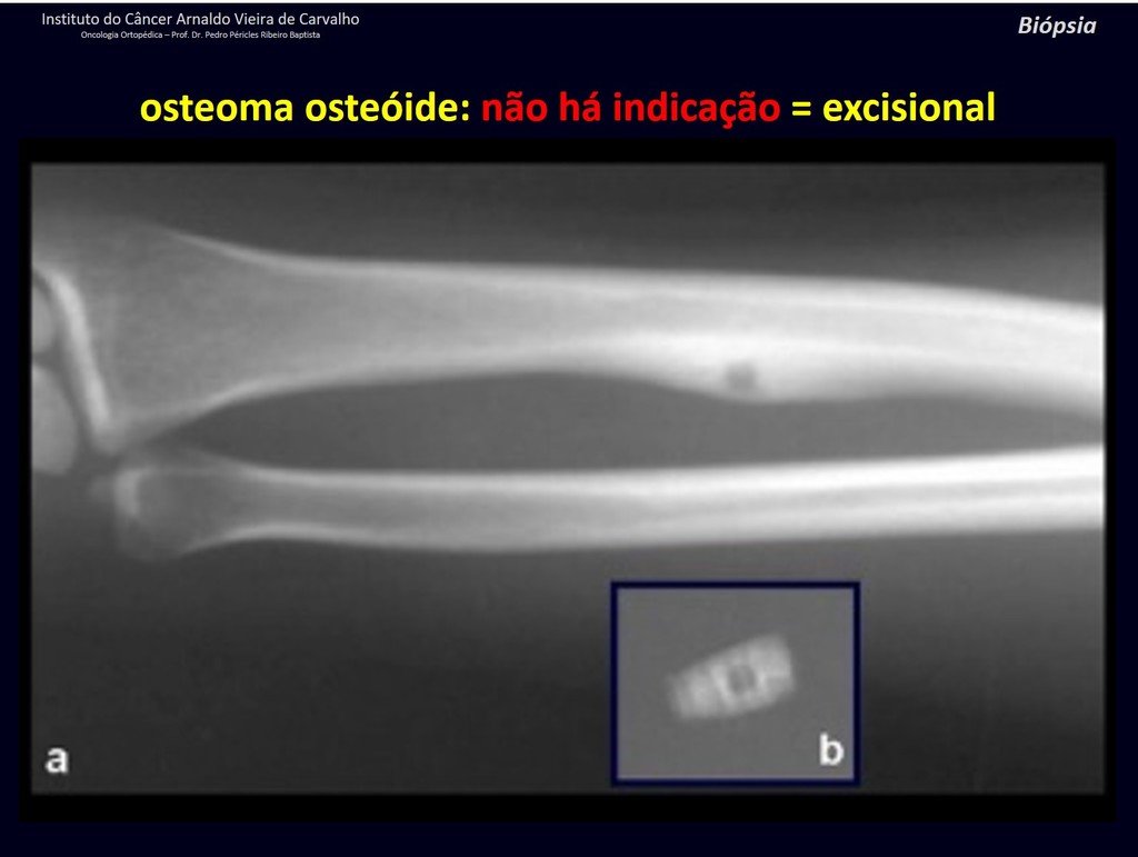 Figura 24: Osteoma osteóide periosteal da cortical interna do rádio. Não há indicação de biópsia.