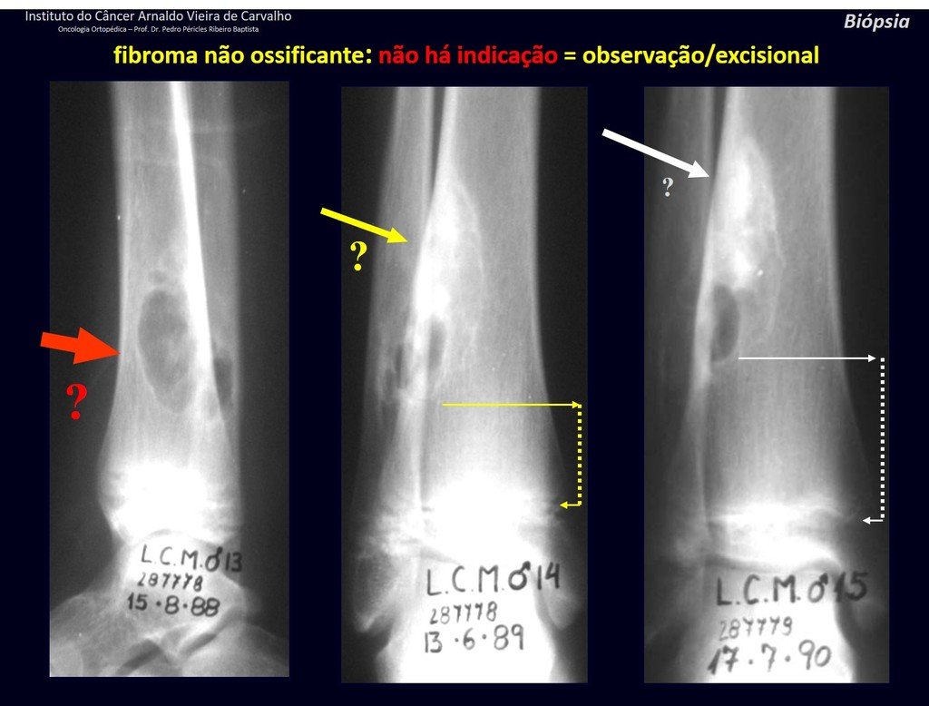 Figura 64: Lesão circunscrita na cortical lateral da tíbia, maior que 1.5 cm. Neste fibroma não ossificante, observamos que a lesão se distancia da linha epifisial e ocorre discreta mineralização. Achado de exame, acompanhamento sem biópsia.