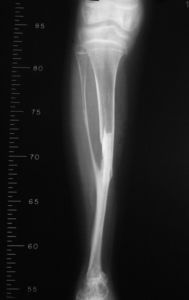 Figura 39: Radiografia frente, após um ano da cirurgia. Fíbula integrada e já tibializada com significativo espessamento cortical.