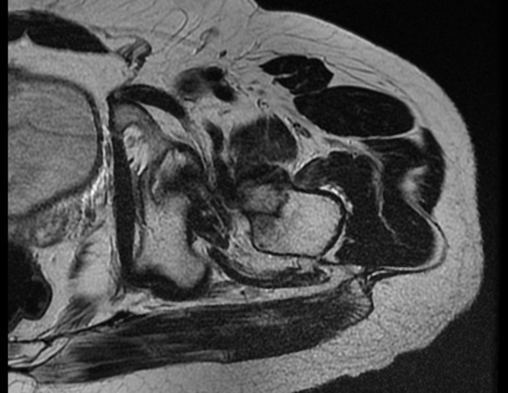 Figura 52: RM axial, lesão lítica acima do pequeno trocânter e edema na medular.