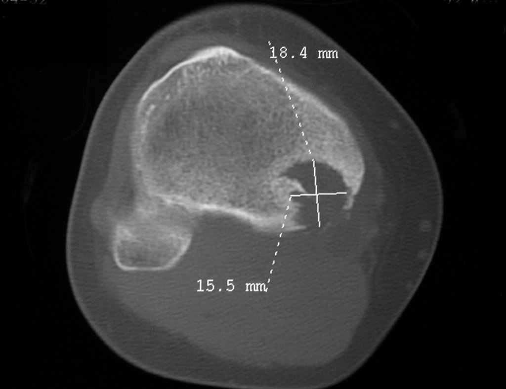 Figura 10: Tomografia (TC) ax, lesão de rarefação óssea, agressiva localmente, com destruição da cortical póstero-medial.