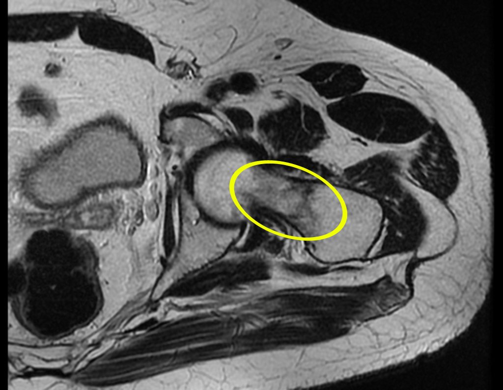 Figura 46: RM axial T1 com edema no colo femoral e evidente traço de fratura incompleto.