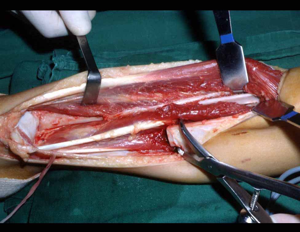 Figura 11: Tumor ressecado, exposição do tálus e da região distal da fíbula para transposição.