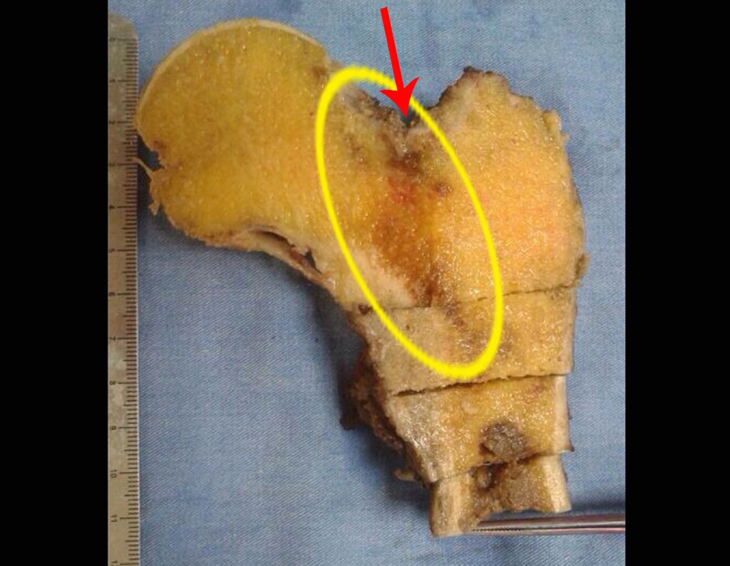 Figura 111: O círculo em amarelo evidencia a área da fratura trabecular no colo. A seta em vermelho aponta a ruptura na cortical.