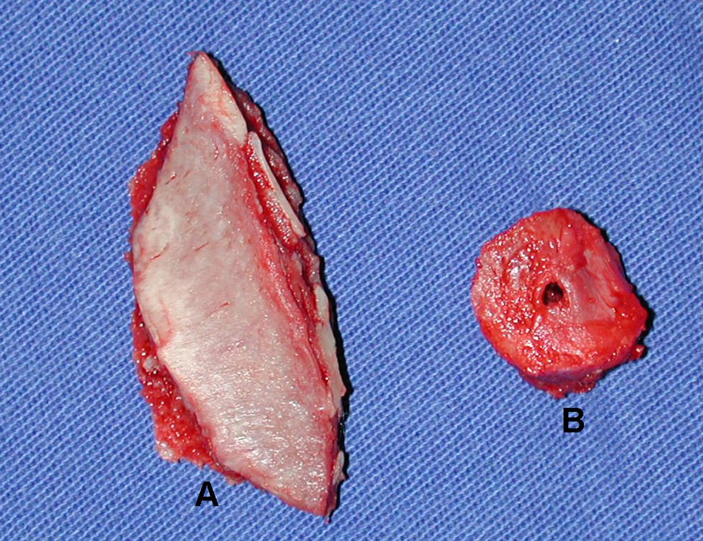 Figura 38: A - enxerto da asa do ilíaco ressecado, para ser moldado conforme o segmento B, ressecado com a trefina.