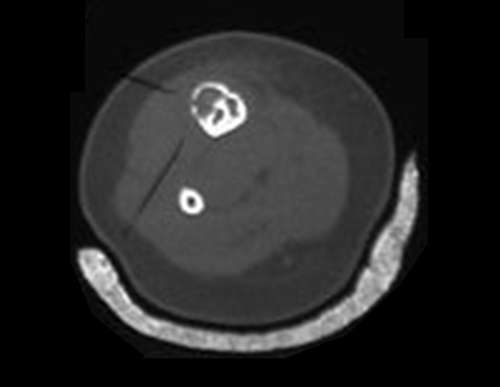 Figura 6: Existe um tecido displásico em crescimento, sob a cortical óssea.