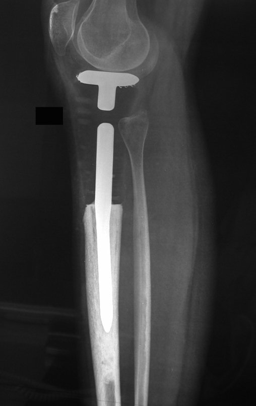 Figura 103: Radiografia em perfil, após oito meses, boa fixação e alinhamento.