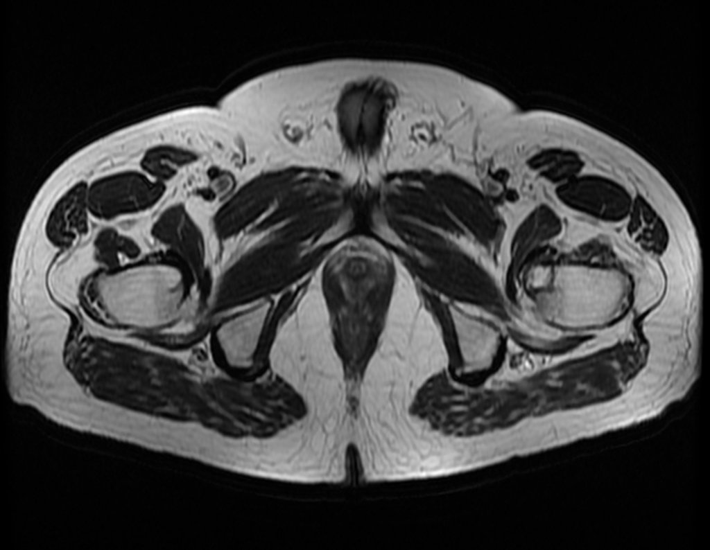 Figura 28: Lesão no pequeno trocânter, com discreto edema e erosão da cortical póstero-medial.