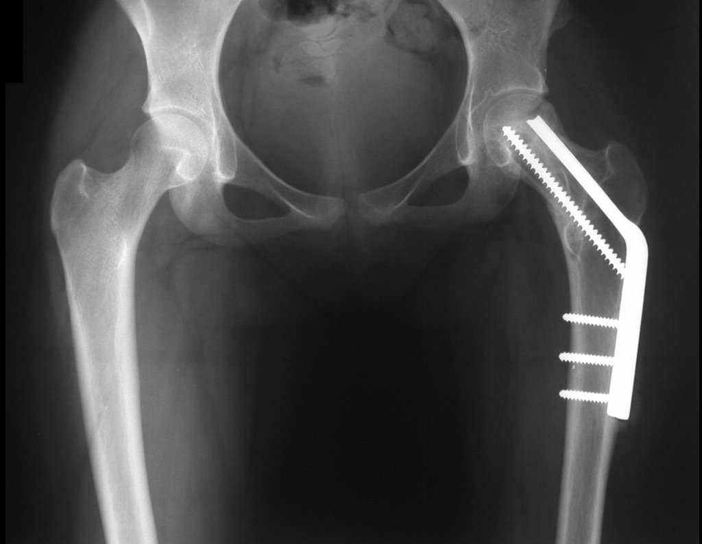 Figura 90: Radiografias de controle de 12/04/2005, frente, após sete meses da cirurgia, reconstituição anatômica do colo femoral.