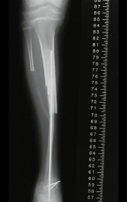 Figura 21: Radiografia frente do autotransplante da fíbula vascularizada, transferindo a cartilagem de crescimento para substituir a que foi ressecada da tíbia.