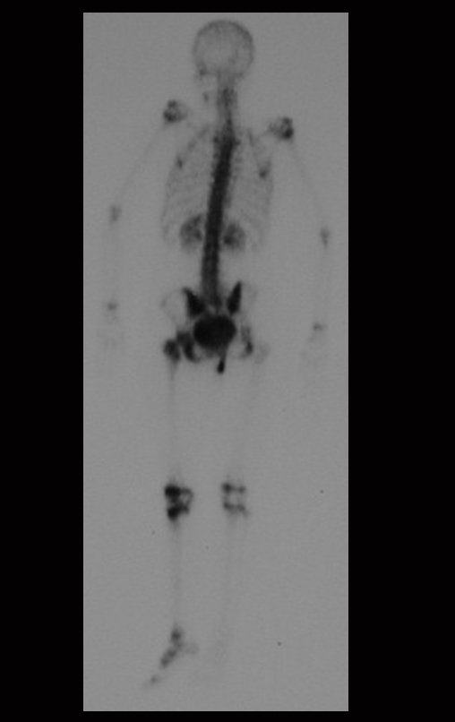 Figura 10: Cintilografia óssea, fase tardia, incidência posterior, inclinação pélvica e captação no quadril esquerdo devido à fratura.