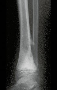 Figura 2: Radiografia perfil do tornozelo direito, com osteossarcoma da região distal da tíbia.