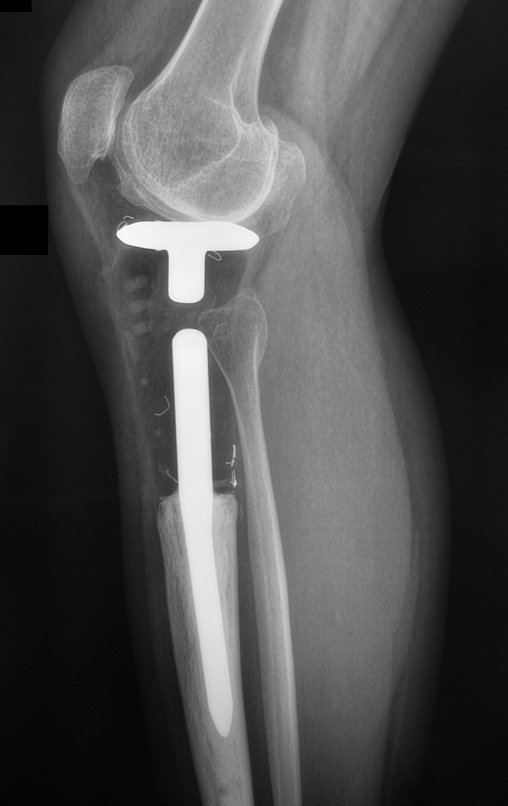 Figura 137: Radiografia, perfil. Pós-operatório de cinco anos.