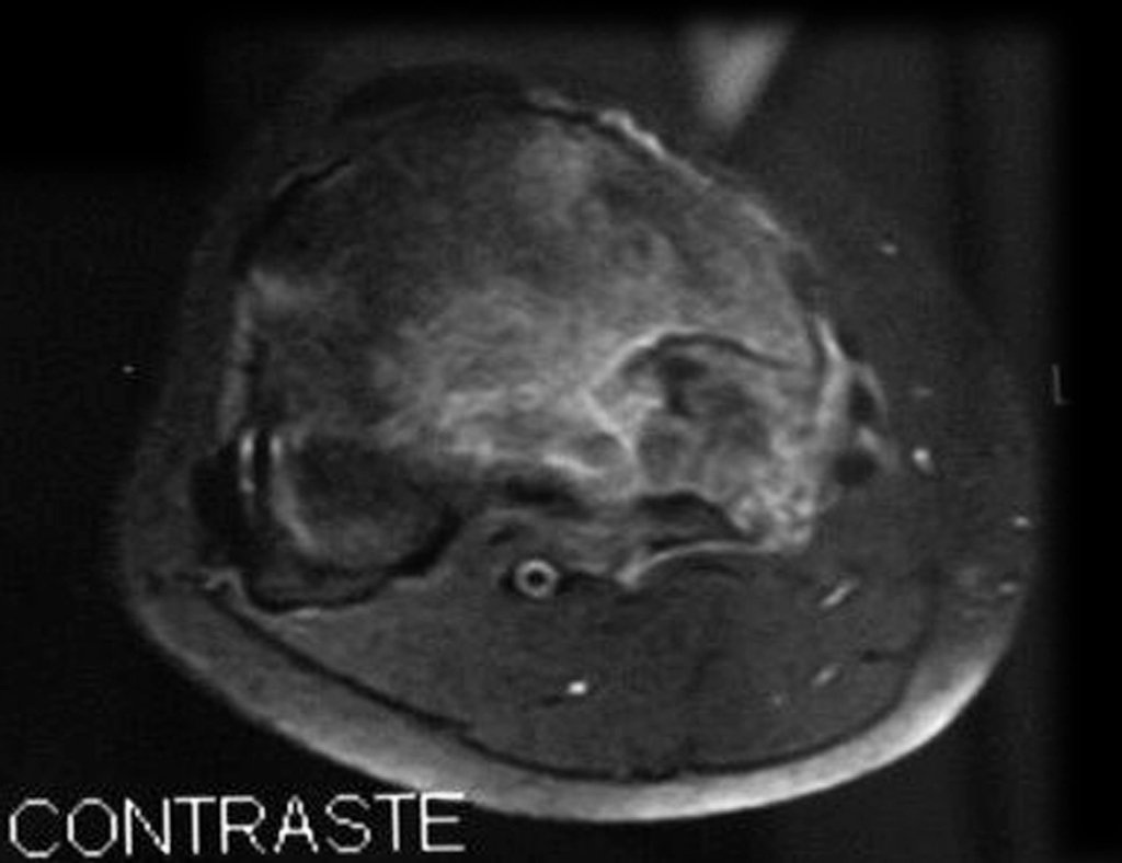 Figura 9: RM ax T1, evidencia lesão heterogênea com captação de contraste.