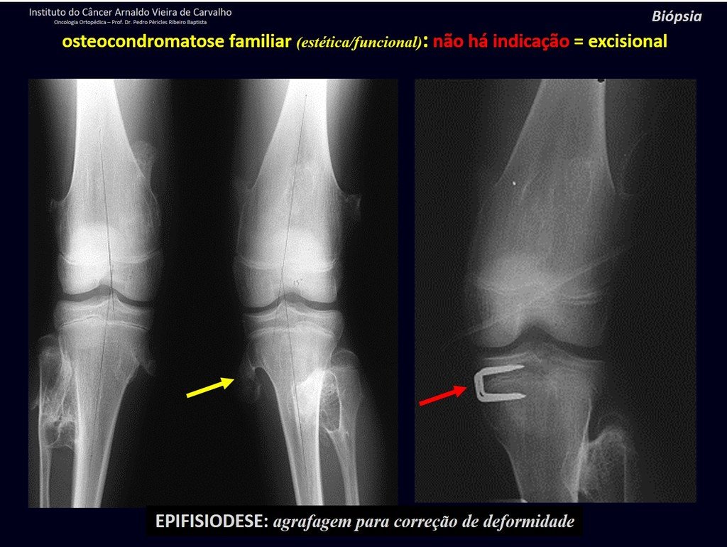 Figura 30: Osteocondroma múltiplos nos fêmures e nas tíbias. Epifisiodese medial da tíbia esquerda visando corrigir a deformidade angular.