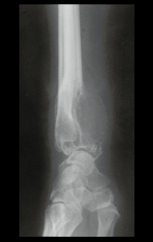 Figura 2: Radiografia evidenciando a insuflação da cortical, em lesão lítica epifisária do rádio.