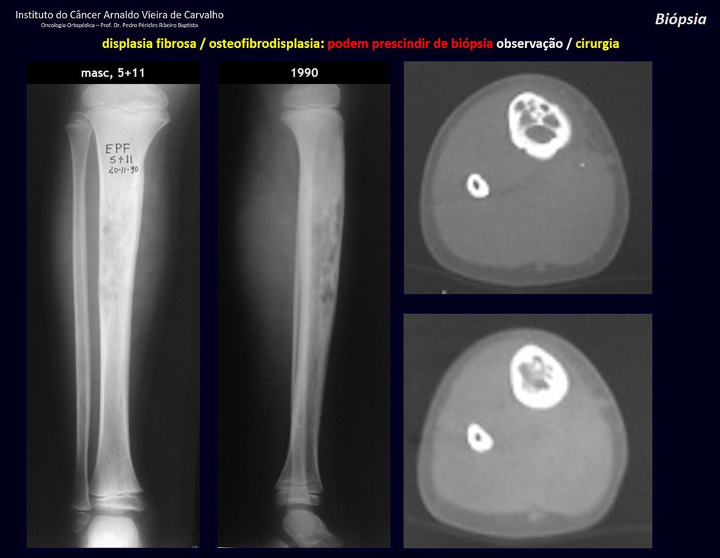 Figura 67: Paciente com cinco anos de idade. Em 1990, foi encaminhado para “amputação” devido a lesão na tíbia! Displasia fibrosa? Osteofibrodisplasia? Adamantinoma da tíbia? Conduta: OBSERVAÇÃO.