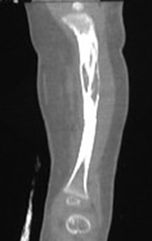 Figura 8: Pode-se verificar pela radiografia que a deformidade nem é contemplada pela curta goteira gessada.