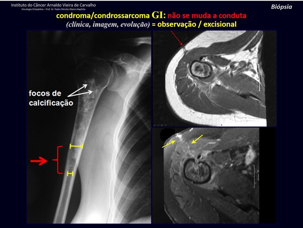 Figura 47: Radiografia de lesão no úmero, com todas as características de agressividade da lesão cartilaginosa: dor, erosão da cortical, alargamento do canal medular por atividade do tumor - o comportamento não é latente: é ativo e agressivo. Na ressonância podemos acompanhar o trajeto da biópsia, contaminado pela implantação da neoplasia.