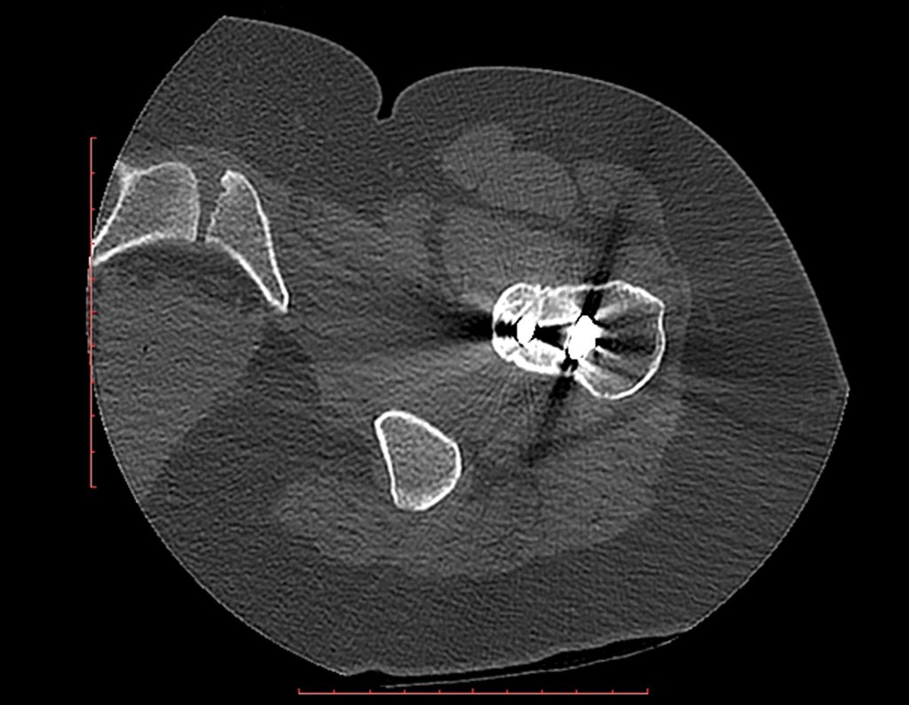 Figura 103: Tomografia do colo femoral operado, após doze anos, imagem com artefato da lâmina e do parafuso.