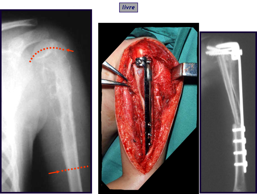 Figura 61: Sarcoma de Ewing do úmero, quimioterapia, cirurgia de ressecção e reconstrução biológica autóloga com fíbula e enxerto estrutural de crista ilíaca.