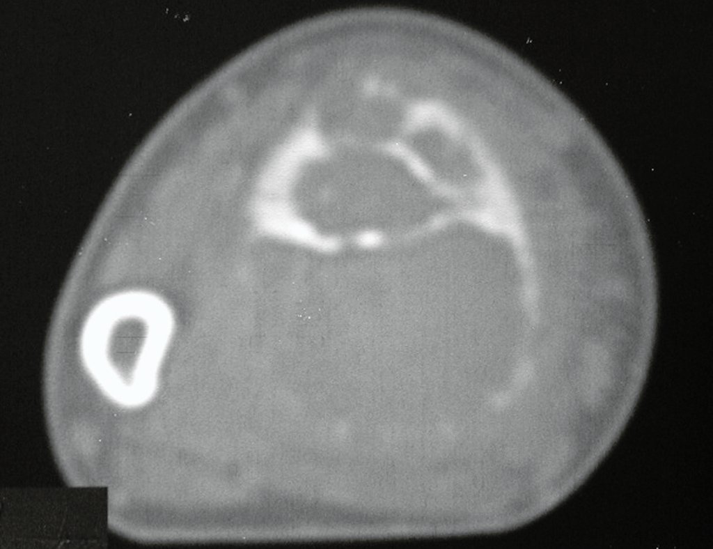 Figura 6: TC, densidade para tecidos moles, evidencia a lesão delimitada externamente pela cortical, sobrepondo-se à parede da cortical proximal, tanto volar como dorsal, porém sem tumor extracortical e sem invasão de tecidos moles.