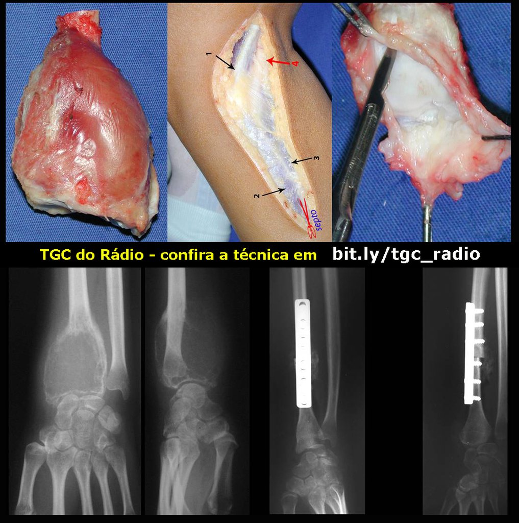 Figura 66: Peça ressecada. Obtenção de enxerto autólogo de fíbula. Reconstrução do punho.