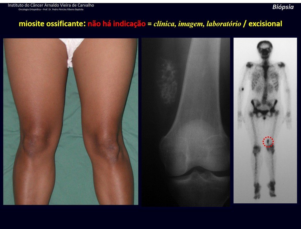 Figura 71: Dor na face medial da coxa esquerda havia oito meses, após trauma. Hipotrofia do quadríceps denotando lesão cônica. Radiografia e cintilografia revelando ossificação.