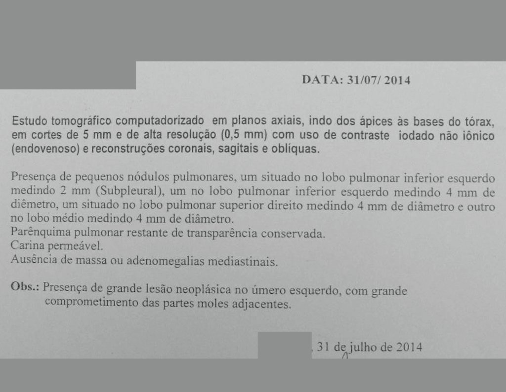 Figura 13: Laudo da tomografia, relatando a presença de nódulos pulmonares.