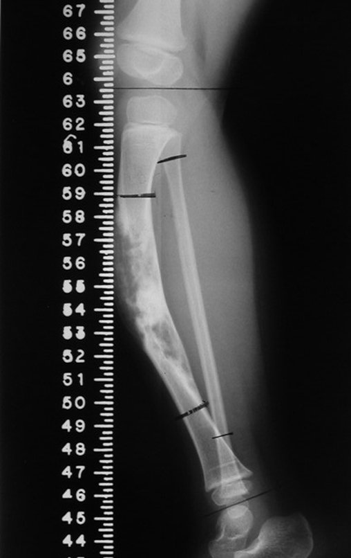 Figura 91: Planejamento pré-operatório, radiografia com régua, perfil, com a marcação dos níveis das osteotomias.