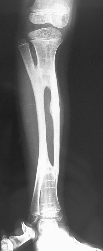 Figura 121: Radiografia de 29/05/2012, com fratura de stress!!!